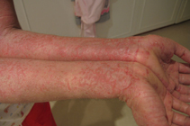 Eczema
