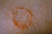 Ringworm