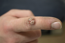 Warts